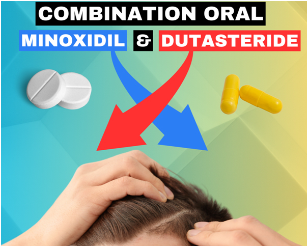 oral minoxidil and dutasteride for hair loss treatment