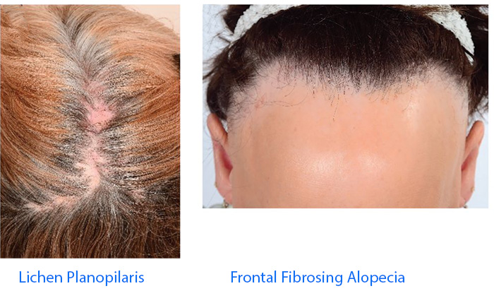 lichen planopilaris and frontal fibrosing alopecia.